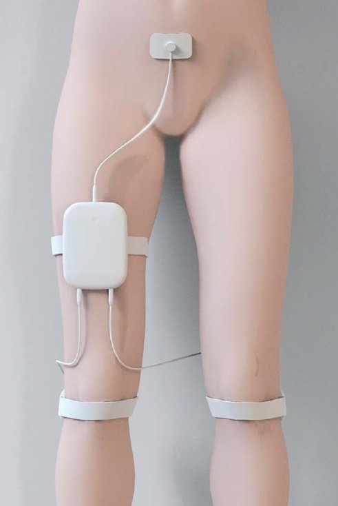 Peroneální elektrická transkutánní neuromodulace Peroneální elektrická transkutánní neuromodulace